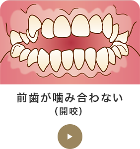 前歯が噛み合わない（開咬） 