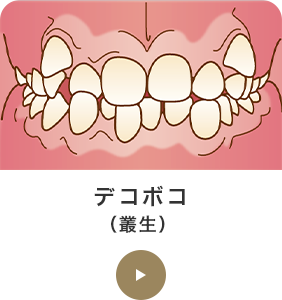 デコボコ（叢生） 
