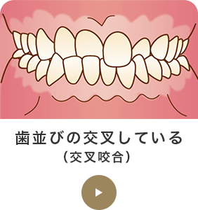 歯並びの交叉している（交叉咬合） 