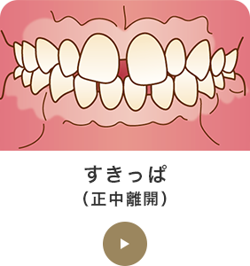 すきっぱ（正中離開）