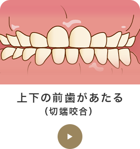 上下の前歯があたる（切端咬合） 